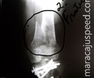 Idosa com fratura no fêmur espera há 12 dias por cirurgia Idosa com fratura no fêmur espera há 12 dias por cirurgia