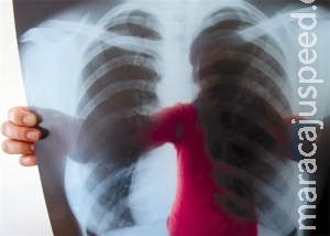 Tuberculose está entre as cinco principais causas de morte de mulheres no país Tuberculose está entre as cinco principais causas de morte de mulheres no país