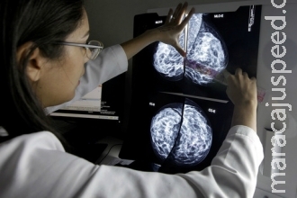 Pesquisa brasileira pode aumentar longevidade de pacientes com câncer de pulmão