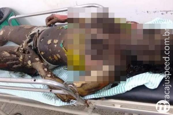 Mãe que pôs fogo em casa com crianças dentro está em estado gravíssimo Mãe que pôs fogo em casa com crianças dentro está em estado gravíssimo