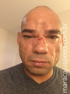 Evangelista Cyborg passa bem após cirurgia de sete horas Evangelista Cyborg passa bem após cirurgia de sete horas
