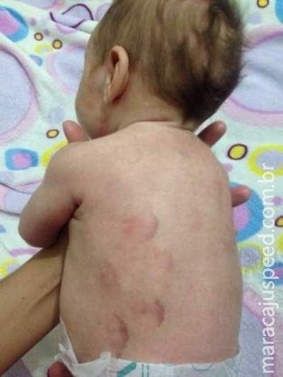 Irritado com choro, pai espanca e morde bebê de 40 dias por todo o corpo