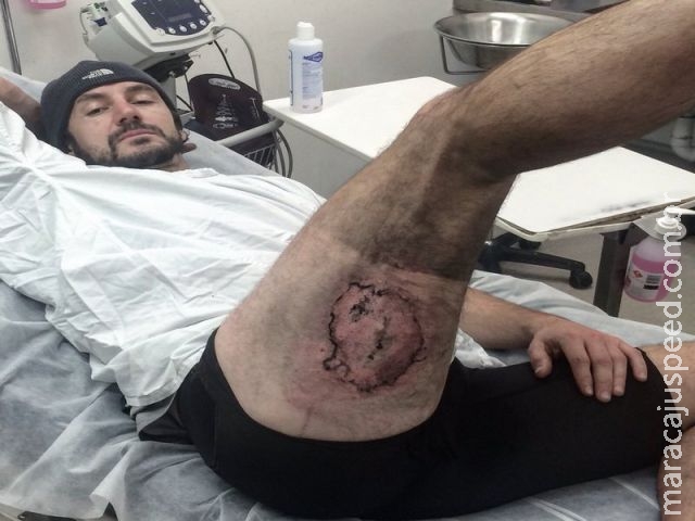  Ciclista cai e iPhone em seu bolso explode, causando queimaduras de 3° grau