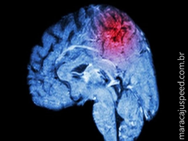 O que são os miniderrames cerebrais - e como eles podem ser um alerta de algo mais grave O que são os miniderrames cerebrais - e como eles podem ser um alerta de algo mais grave