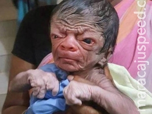 Menino " Benjamin Button " nasce em Bangladesh Menino " Benjamin Button " nasce em Bangladesh
