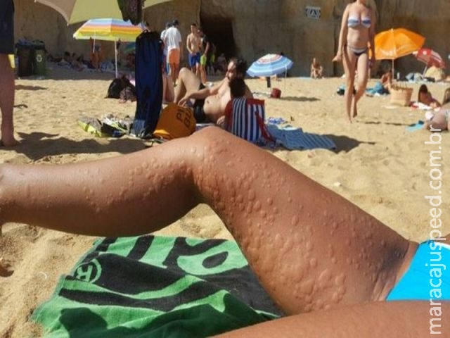 "Respingo de água fria já deixou minha pele irritada ": como é viver com alergia ao frio "Respingo de água fria já deixou minha pele irritada ": como é viver com alergia ao frio