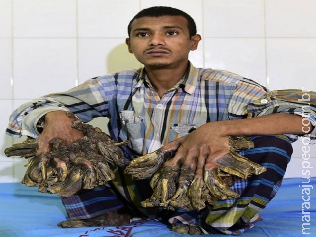 " Homem-árvore" passa por cirurgias para retirar verrugas em forma de casca das mãos e pés " Homem-árvore" passa por cirurgias para retirar verrugas em forma de casca das mãos e pés