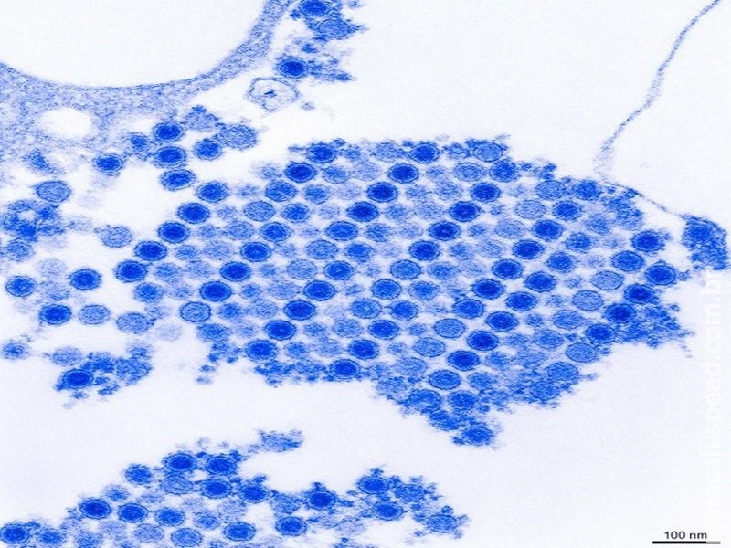 Cientistas testam drogas contra artrite para aliviar sintomas de chikungunya Cientistas testam drogas contra artrite para aliviar sintomas de chikungunya