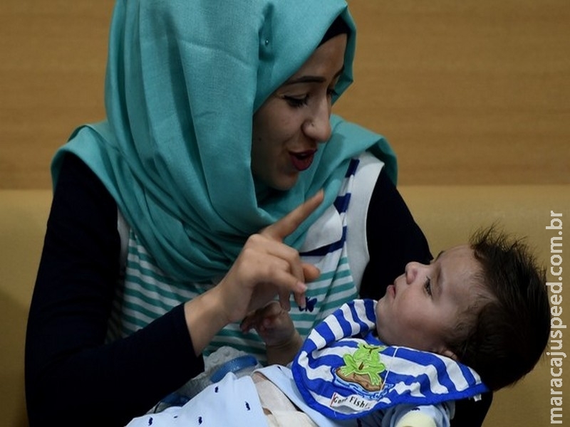 Bebê com 8 braços e pernas é operado com êxito Bebê com 8 braços e pernas é operado com êxito