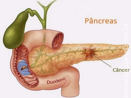 Sucesso do tratamento de câncer de pâncreas está ligado a diagnóstico precoce Sucesso do tratamento de câncer de pâncreas está ligado a diagnóstico precoce