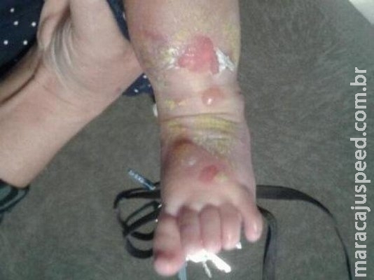 Bebê sofre queimaduras de 2º grau após receber compressa em hospital Bebê sofre queimaduras de 2º grau após receber compressa em hospital