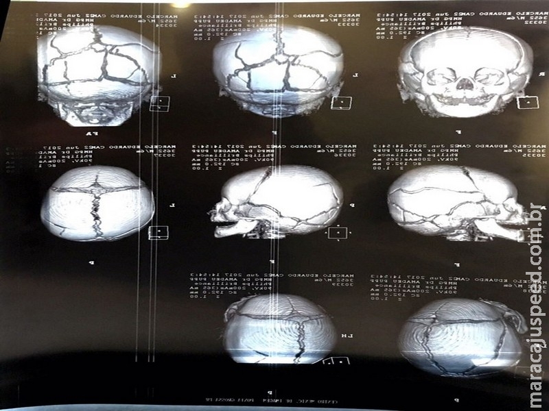  Pai suspeito de agredir filho de seis meses é preso por tortura; criança está na UTI