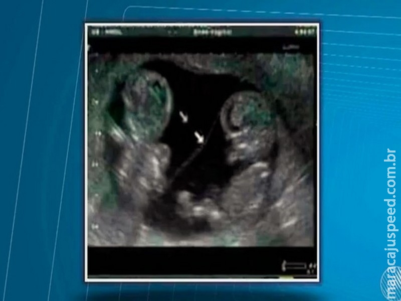 Mulher que estava grávida de gêmeos diz que um dos bebês sumiu após parto em maternidade Mulher que estava grávida de gêmeos diz que um dos bebês sumiu após parto em maternidade