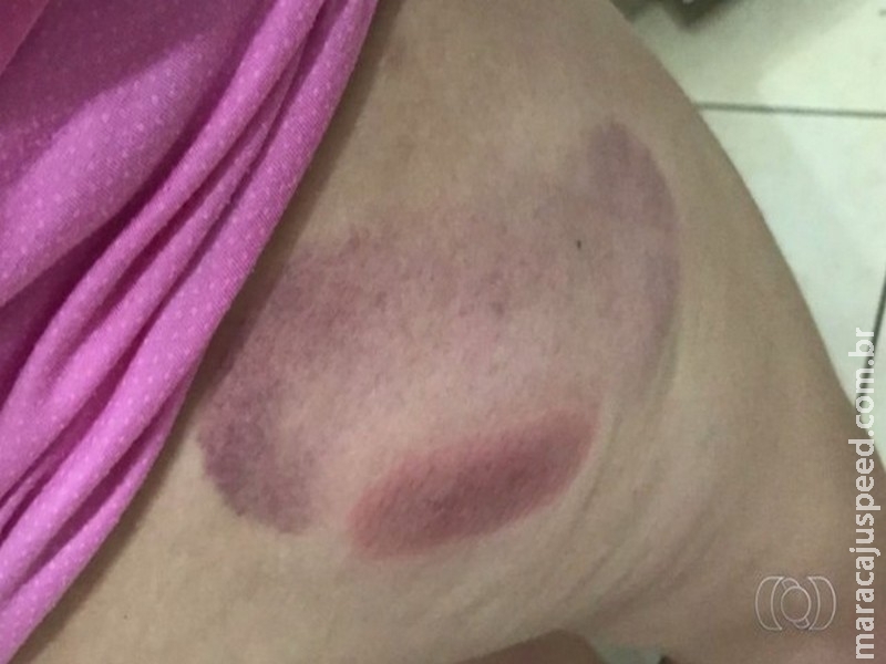 Jovem denuncia que sofreu queimaduras após passar por procedimento estético Jovem denuncia que sofreu queimaduras após passar por procedimento estético