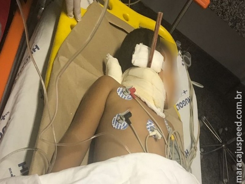 Menino de 3 anos fica com pedaço de madeira transfixado no pescoço após queda Menino de 3 anos fica com pedaço de madeira transfixado no pescoço após queda