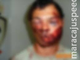 Homem que ficou com rosto deformado após assalto continua em estado grave