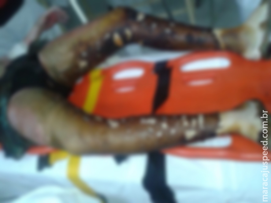 Mulher morre com 100% do corpo queimado após brigar com o marido