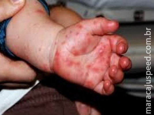 Crianças são diagnosticadas com síndrome mão-pé-boca em creches de Nova Andradina
