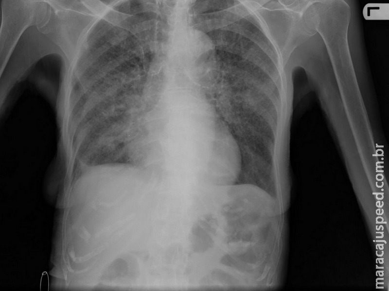 Progresso para acabar com tuberculose nas Américas deve ser acelerado, afirma OPAS