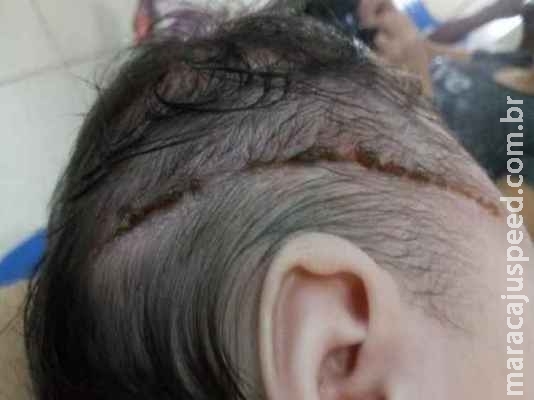Recém-nascida leva 25 pontos após corte na cabeça durante parto Recém-nascida leva 25 pontos após corte na cabeça durante parto