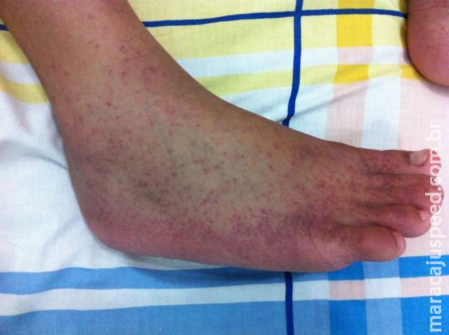 Em 11 meses, dengue cai 13,05%, mas chikungunya sobe e mata 1 na Capital Em 11 meses, dengue cai 13,05%, mas chikungunya sobe e mata 1 na Capital