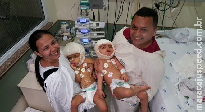 Gêmea siamesa separada vai passar por cirurgia plástica nesta quinta Gêmea siamesa separada vai passar por cirurgia plástica nesta quinta