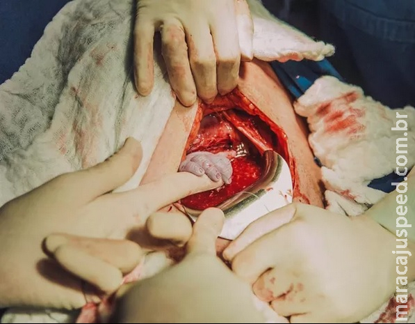 Foto emocionante: bebê segura na mão da obstetra antes mesmo de nascer Foto emocionante: bebê segura na mão da obstetra antes mesmo de nascer