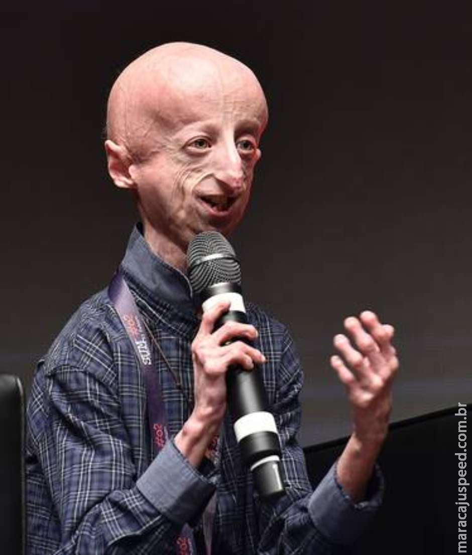  Itália opera coração de paciente com progeria pela 1ª vez