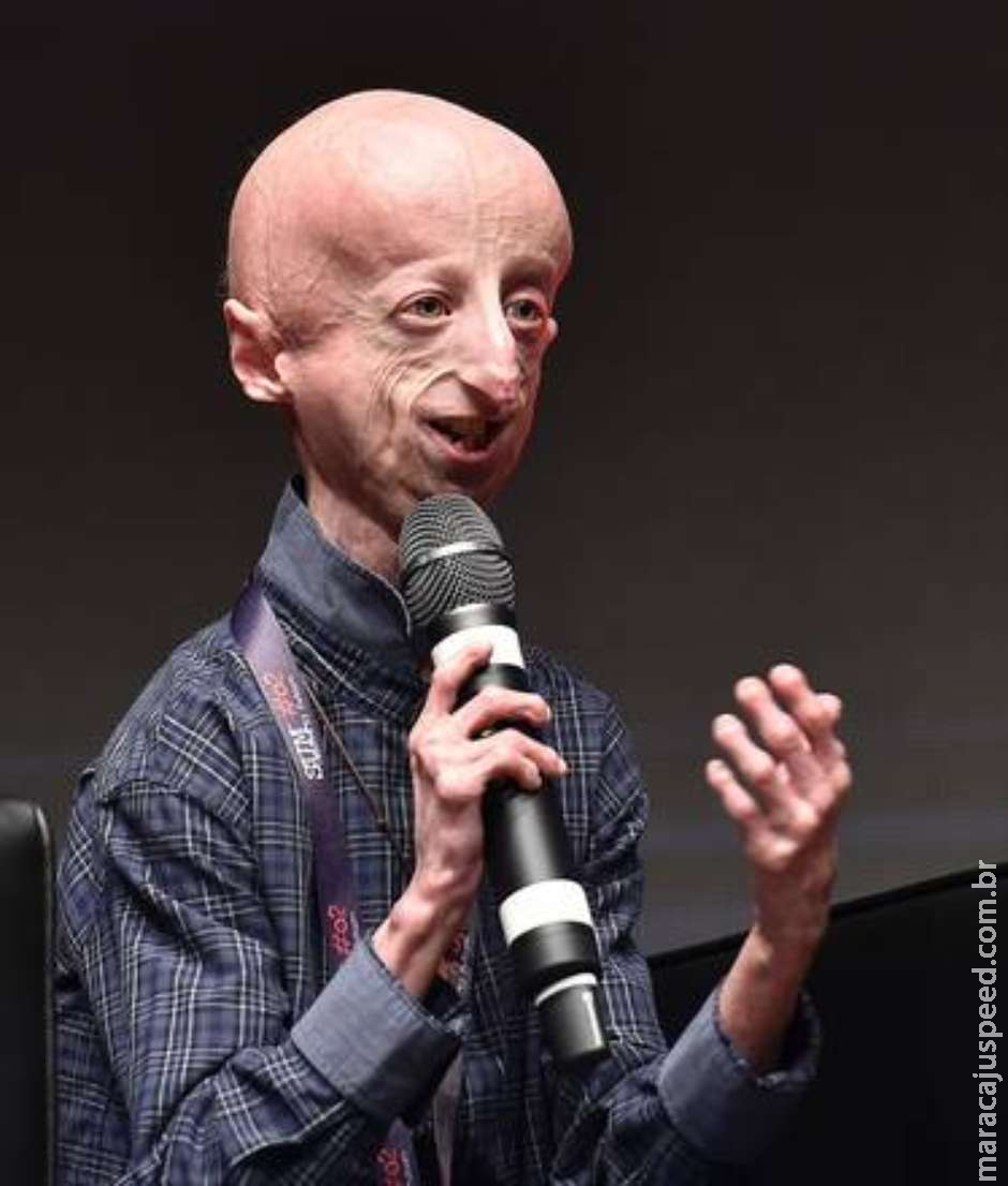 Itália opera coração de paciente com progeria pela 1ª vez Itália opera coração de paciente com progeria pela 1ª vez