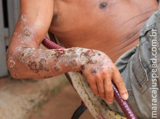 Morador abandonado e doente será levado para unidade de assistência social