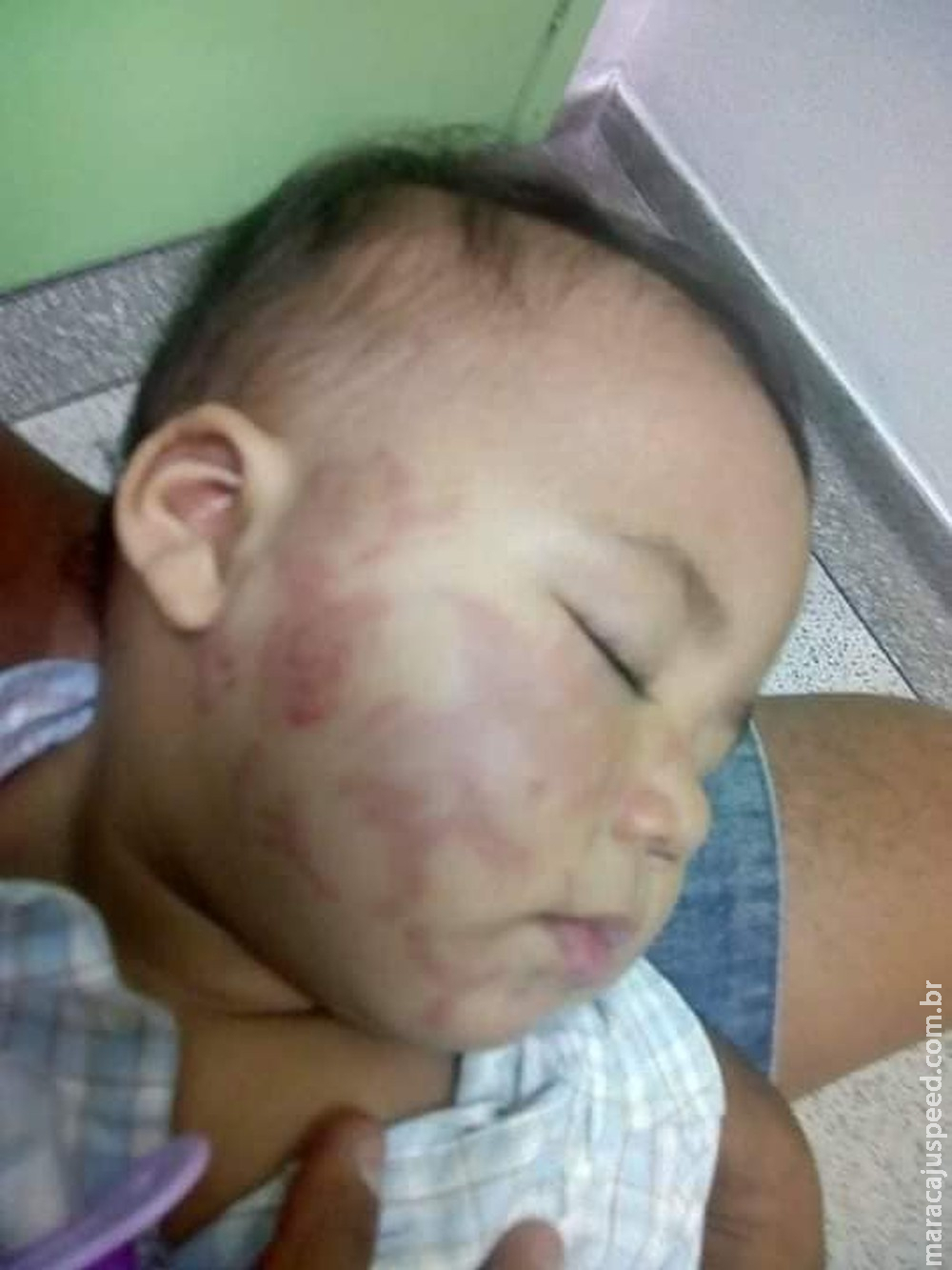 Mãe se desespera ao buscar bebê cheio de mordidas em creche Mãe se desespera ao buscar bebê cheio de mordidas em creche