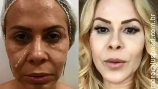 Joelma mostra antes e depois de harmonização facial e choca fãs Joelma mostra antes e depois de harmonização facial e choca fãs