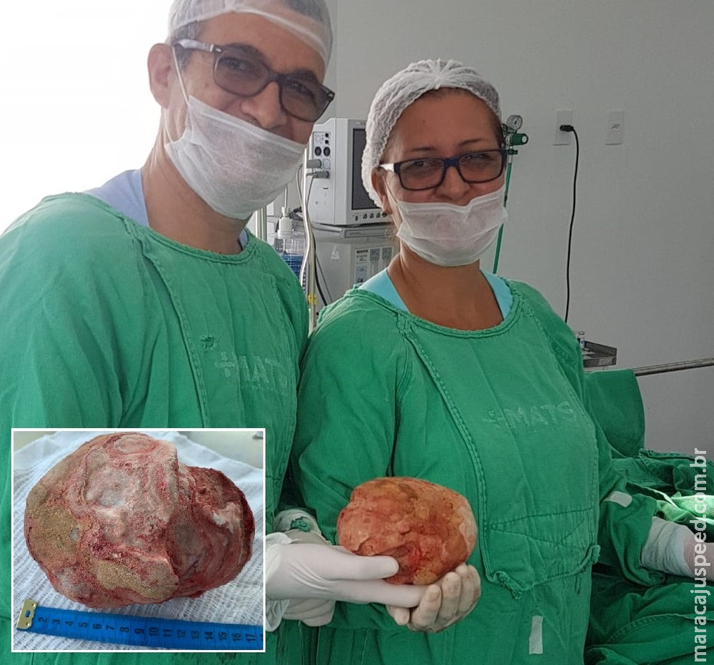 Lavrador de 51 anos tem pedra de 1,3 Kg e 18 cm retirada da bexiga em cirurgia 