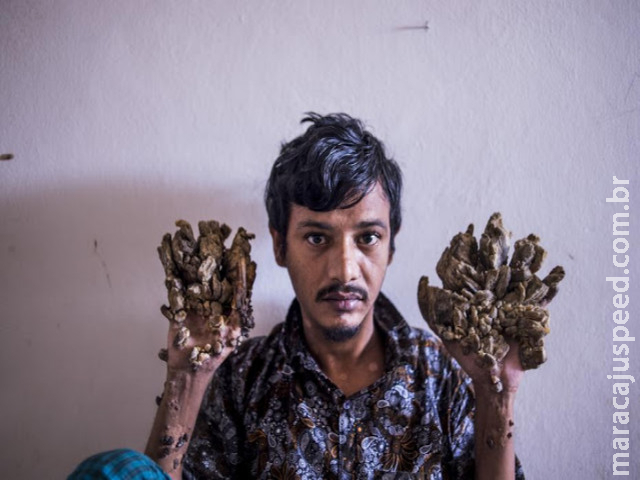 “Homem-árvore” com doença genética conhecida por "Epidermodisplasia Verrucosa" pede para que suas mãos sejam amputadas “Homem-árvore” com doença genética conhecida por "Epidermodisplasia Verrucosa" pede para que suas mãos sejam amputadas