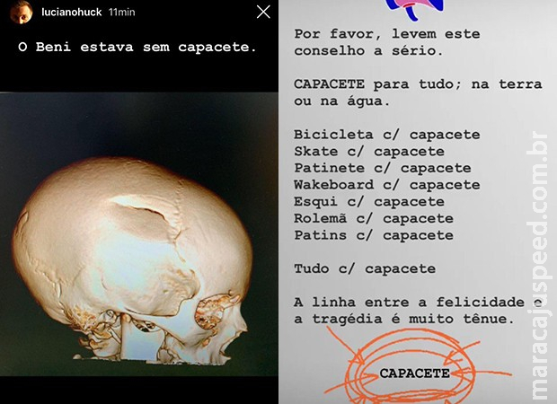 Luciano Huck diz que filho estava sem capacete no momento do acidente Luciano Huck diz que filho estava sem capacete no momento do acidente