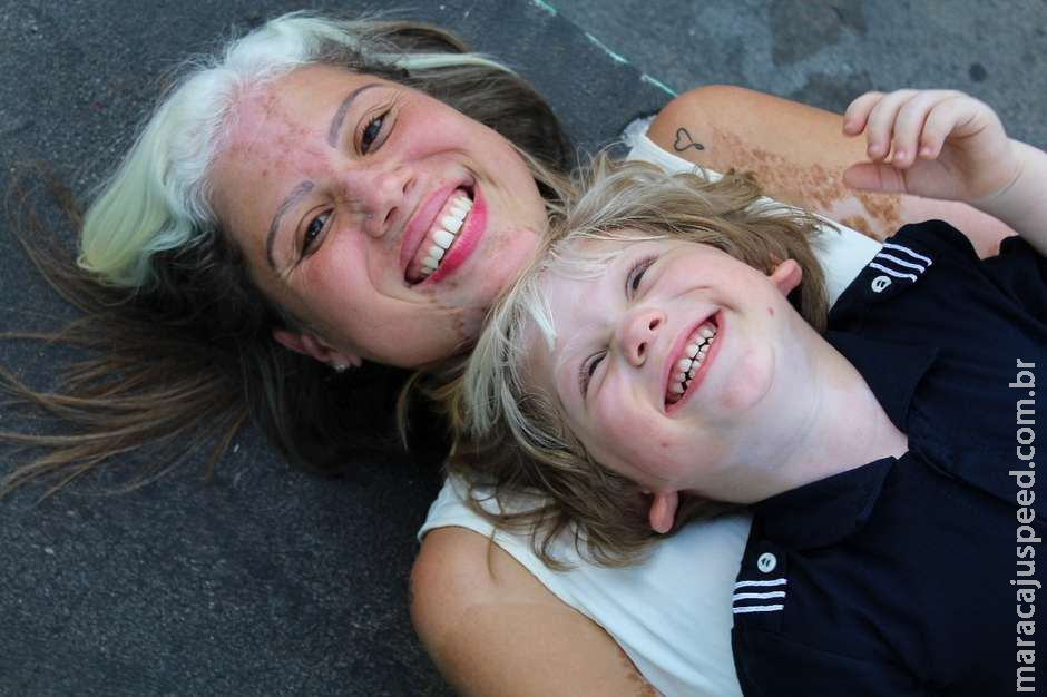 O distúrbio raro que fez mãe e filho nascerem com cabelos brancos O distúrbio raro que fez mãe e filho nascerem com cabelos brancos