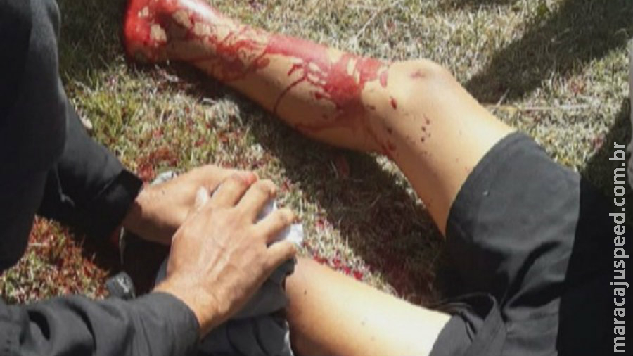 Jovem ferido com linha chilena terá perna amputada Jovem ferido com linha chilena terá perna amputada