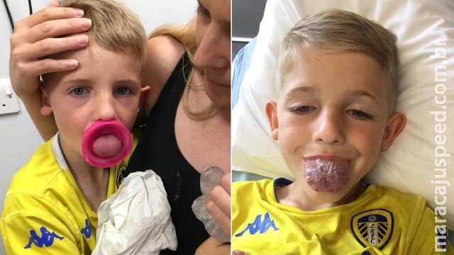 Menino fica com a língua presa na boca de garrafa e passa por arriscada cirurgia de emergência Menino fica com a língua presa na boca de garrafa e passa por arriscada cirurgia de emergência