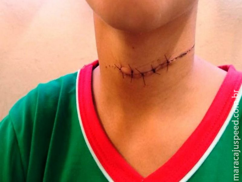 Criança sofre corte no pescoço com linha chilena no interior de MS Criança sofre corte no pescoço com linha chilena no interior de MS