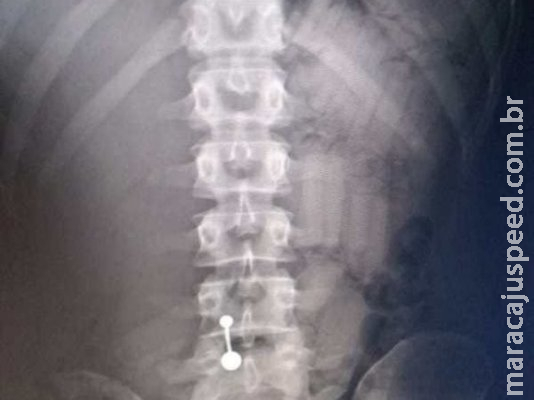 Presa em MS com 50 cápsulas de cocaína no intestino levaria droga até Roma Presa em MS com 50 cápsulas de cocaína no intestino levaria droga até Roma