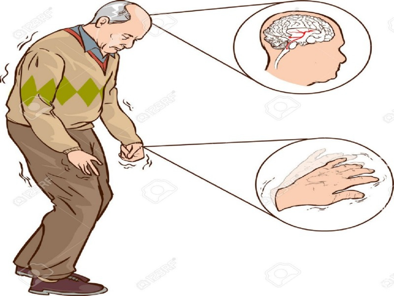 Cientistas descobrem estágios iniciais do mal de Parkinson Cientistas descobrem estágios iniciais do mal de Parkinson