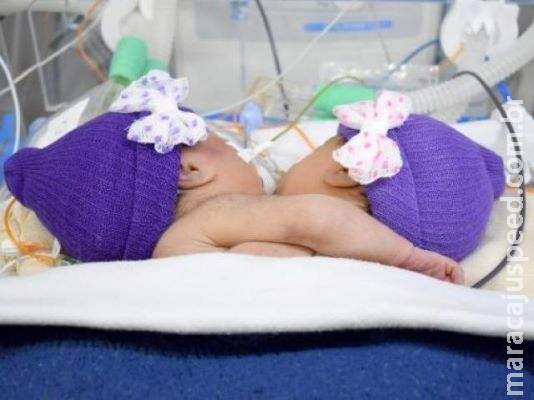 Gêmeas siamesas seguem em estado grave e passam por exames na Santa Casa