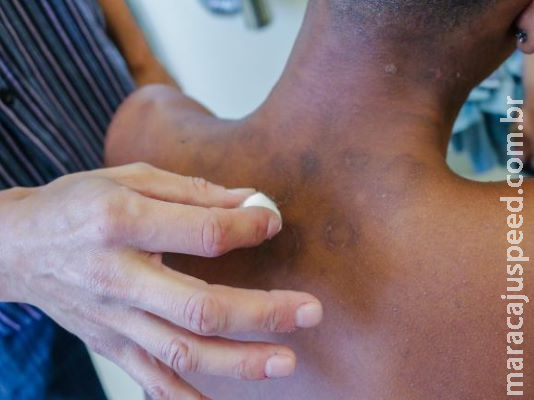 Hanseníase: conheça os sintomas e o tratamento para a doença Hanseníase: conheça os sintomas e o tratamento para a doença