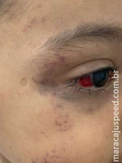 Padrasto tortura menino de 3 anos após criança fazer xixi na cama Padrasto tortura menino de 3 anos após criança fazer xixi na cama