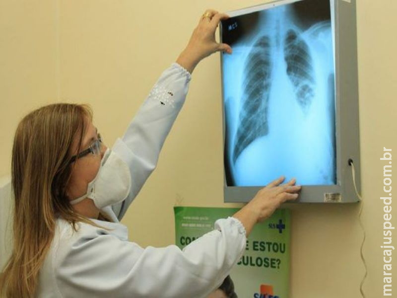 Brasil reduz em 8% o número de mortes por tuberculose na última década Brasil reduz em 8% o número de mortes por tuberculose na última década