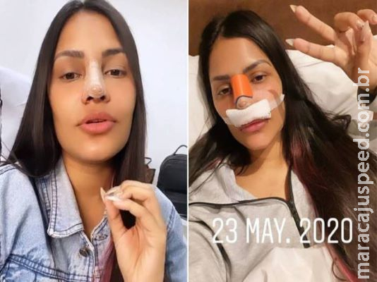 Ex-BBB Flayslane faz rinoplastia e surpreende fãs