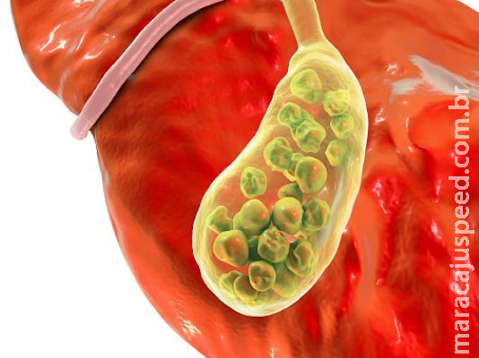 Pedra na vesícula: cálculos que causam dor na região abdominal Pedra na vesícula: cálculos que causam dor na região abdominal