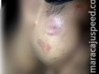 Adolescente de 12 anos é espancada por homem investigado por estuprá-la em MS Adolescente de 12 anos é espancada por homem investigado por estuprá-la em MS