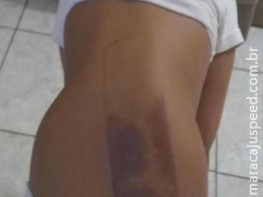 Criança de 7 anos sofre queimaduras nas costas após dormir em cima do celular Criança de 7 anos sofre queimaduras nas costas após dormir em cima do celular