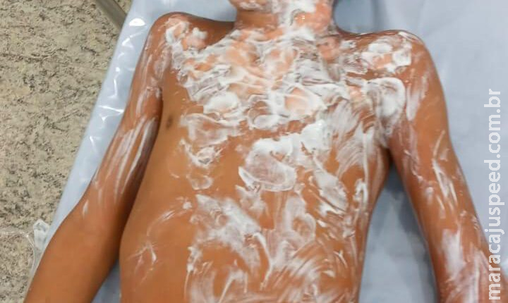 Menino de 8 anos socorrido em chamas após ser abandonado pela avó teve queimaduras no rosto e tórax Menino de 8 anos socorrido em chamas após ser abandonado pela avó teve queimaduras no rosto e tórax